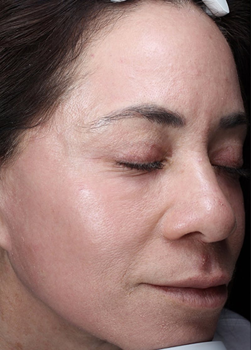 Halo Laser Before & After Gallery - Patient 133024107 - Image 6