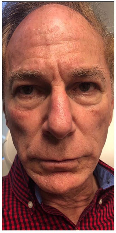 Dermal Fillers Before & After Gallery - Patient 133024108 - Image 1