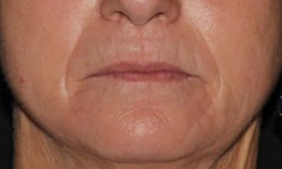 Laser Resurfacing Before & After Gallery - Patient 133024112 - Image 2
