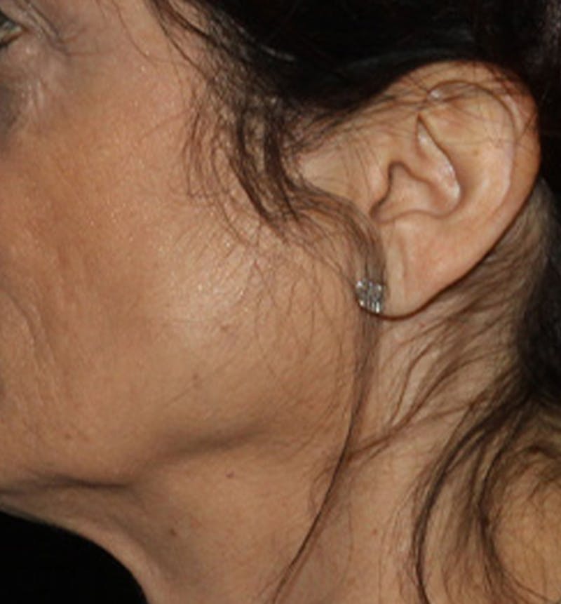 Facelift Scar Before & After Gallery - Patient 133024111 - Image 3