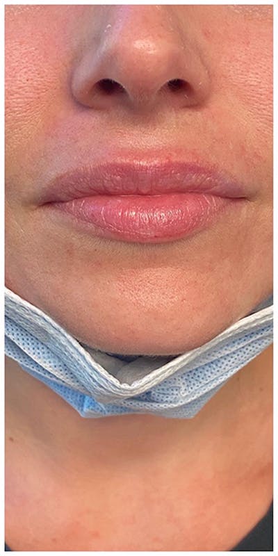 Lip Enhancement Before & After Gallery - Patient 133024119 - Image 1