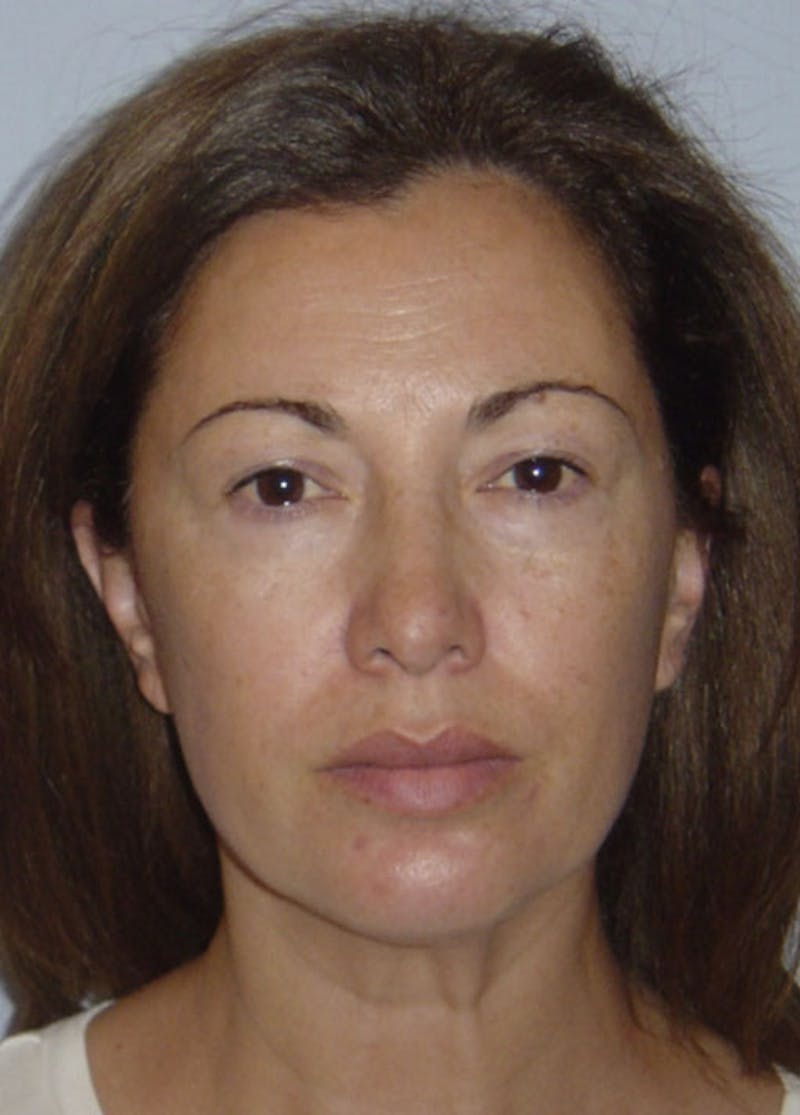 Facelift & Necklift Before & After Gallery - Patient 133024118 - Image 1