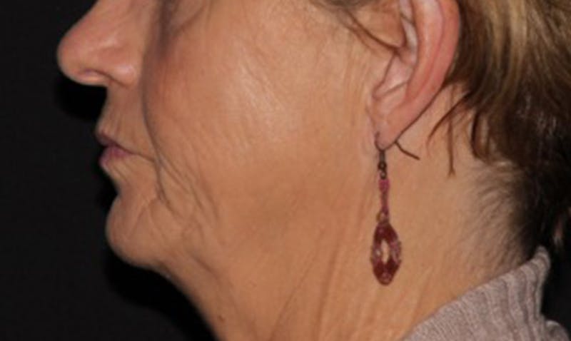 Laser Resurfacing Before & After Gallery - Patient 133024112 - Image 3