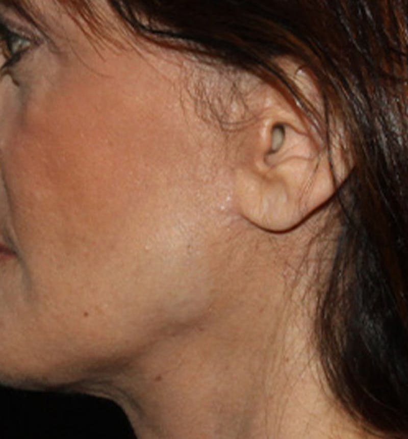 Facelift Scar Before & After Gallery - Patient 133024111 - Image 4