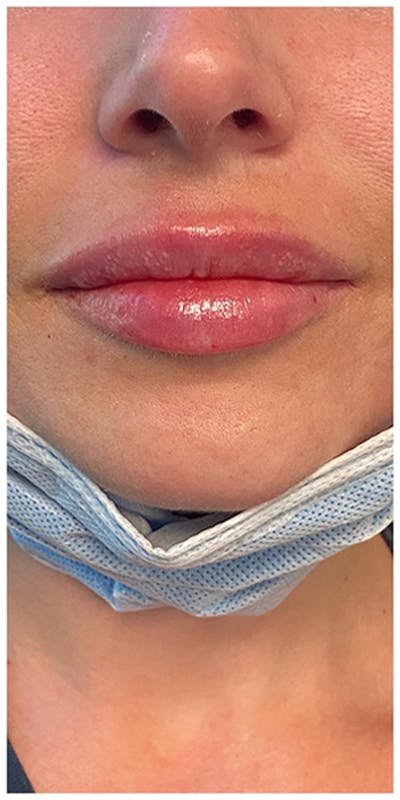 Lip Enhancement Before & After Gallery - Patient 133024119 - Image 2