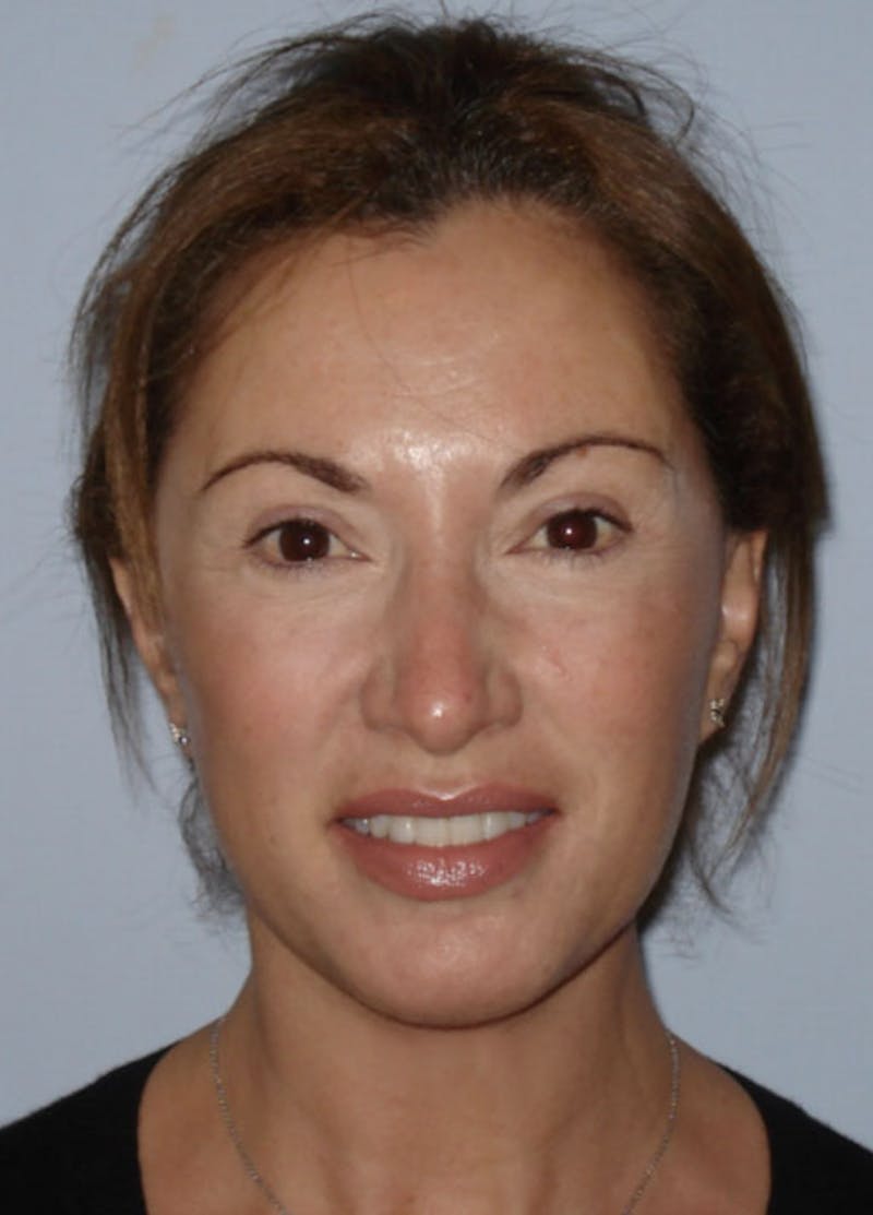 Facelift & Necklift Before & After Gallery - Patient 133024118 - Image 2