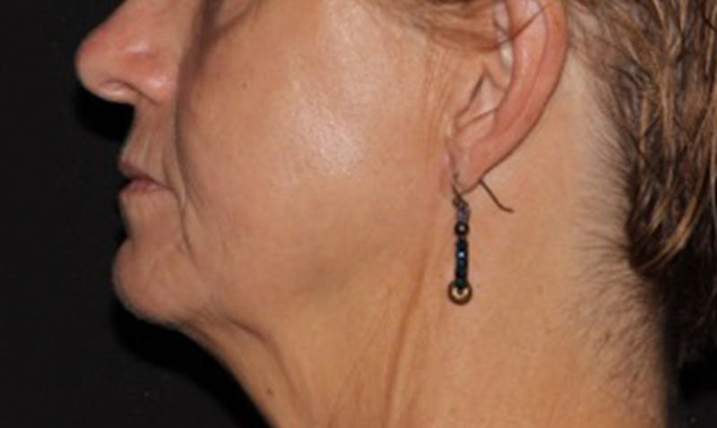 Laser Resurfacing Before & After Gallery - Patient 133024112 - Image 4