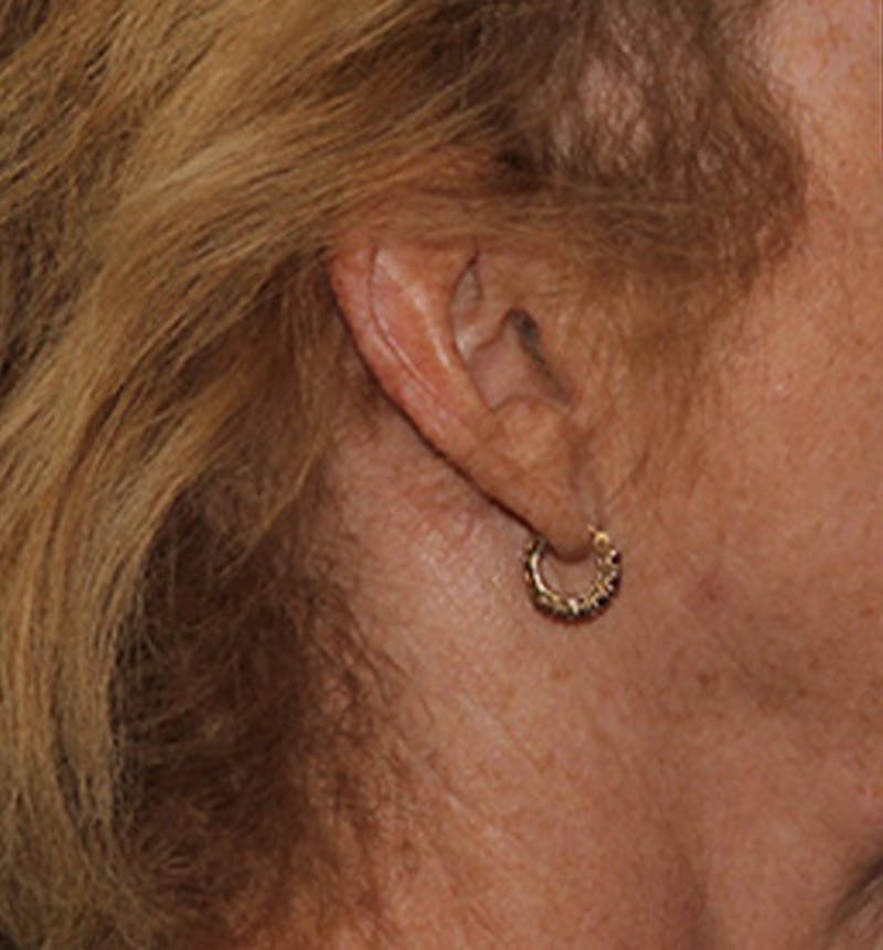 Facelift Scar Before & After Gallery - Patient 133024117 - Image 1