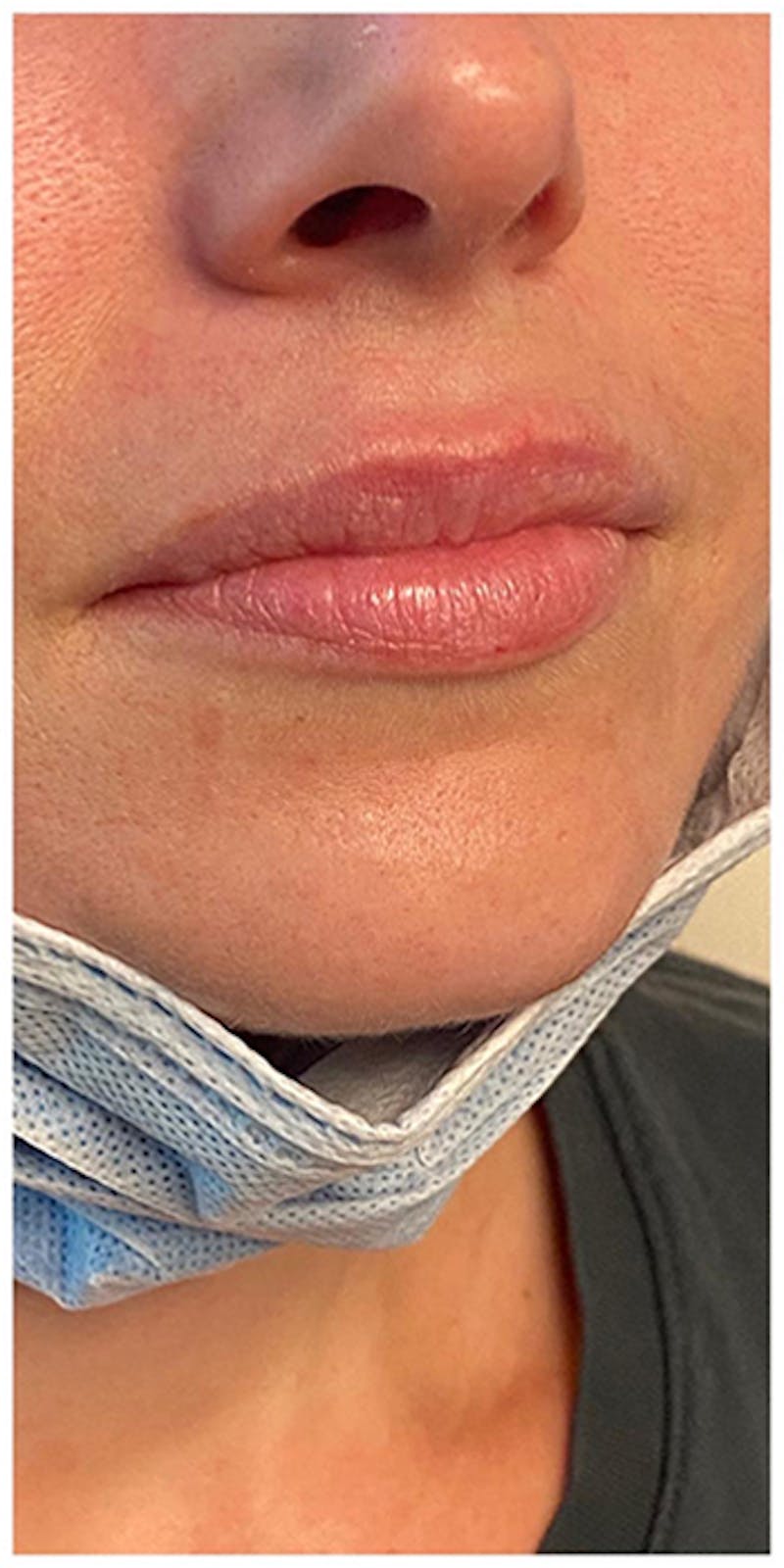 Lip Enhancement Before & After Gallery - Patient 133024119 - Image 3