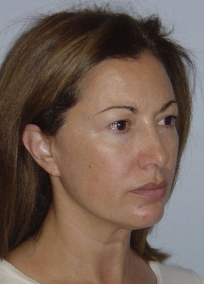 Facelift & Necklift Before & After Gallery - Patient 133024118 - Image 3