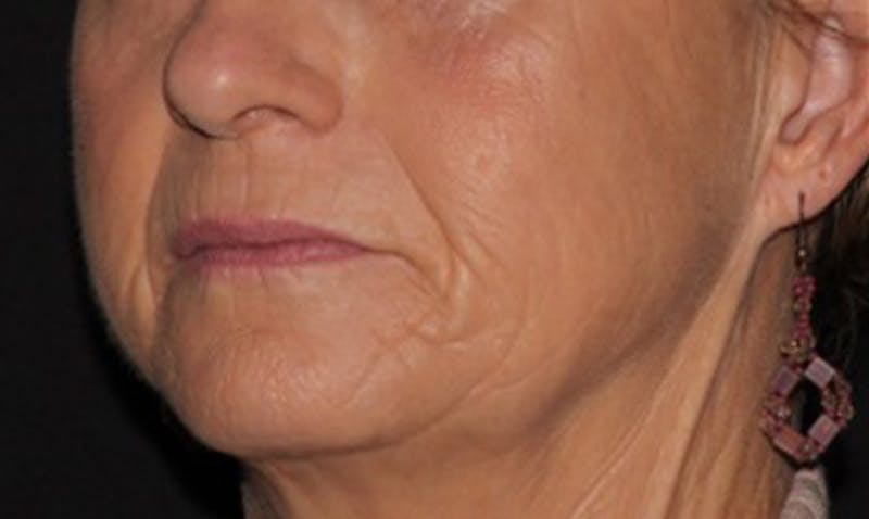 Laser Resurfacing Before & After Gallery - Patient 133024112 - Image 5