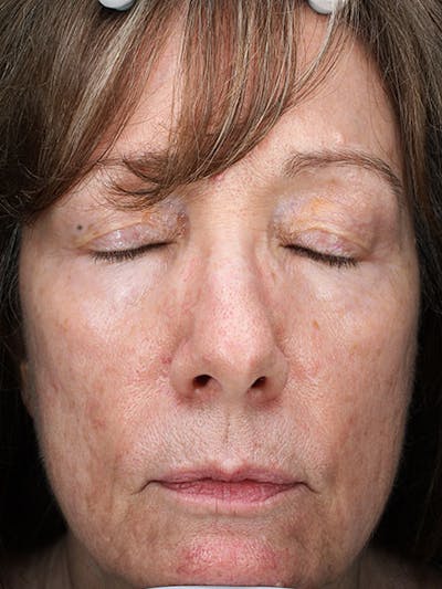 Skinpen / Microneedling Before & After Gallery - Patient 133024120 - Image 1
