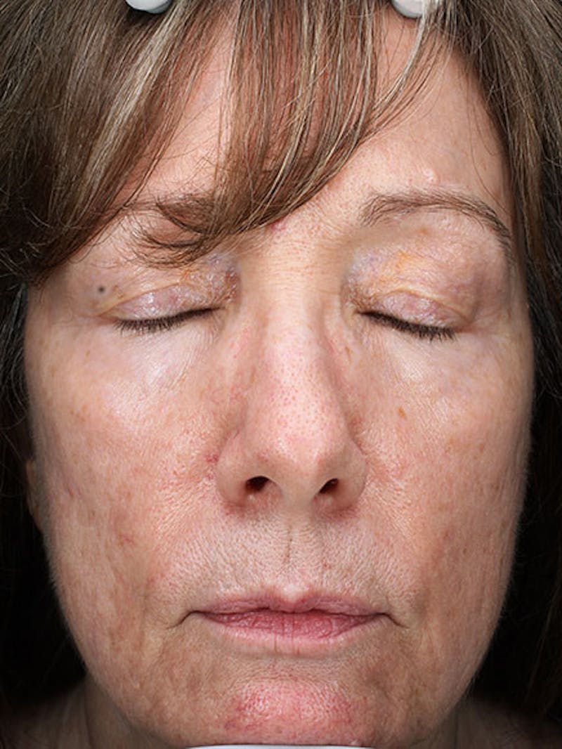 Skinpen / Microneedling Before & After Gallery - Patient 133024120 - Image 1