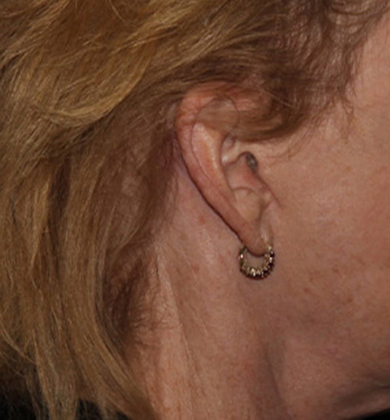 Facelift Scar Before & After Gallery - Patient 133024117 - Image 2