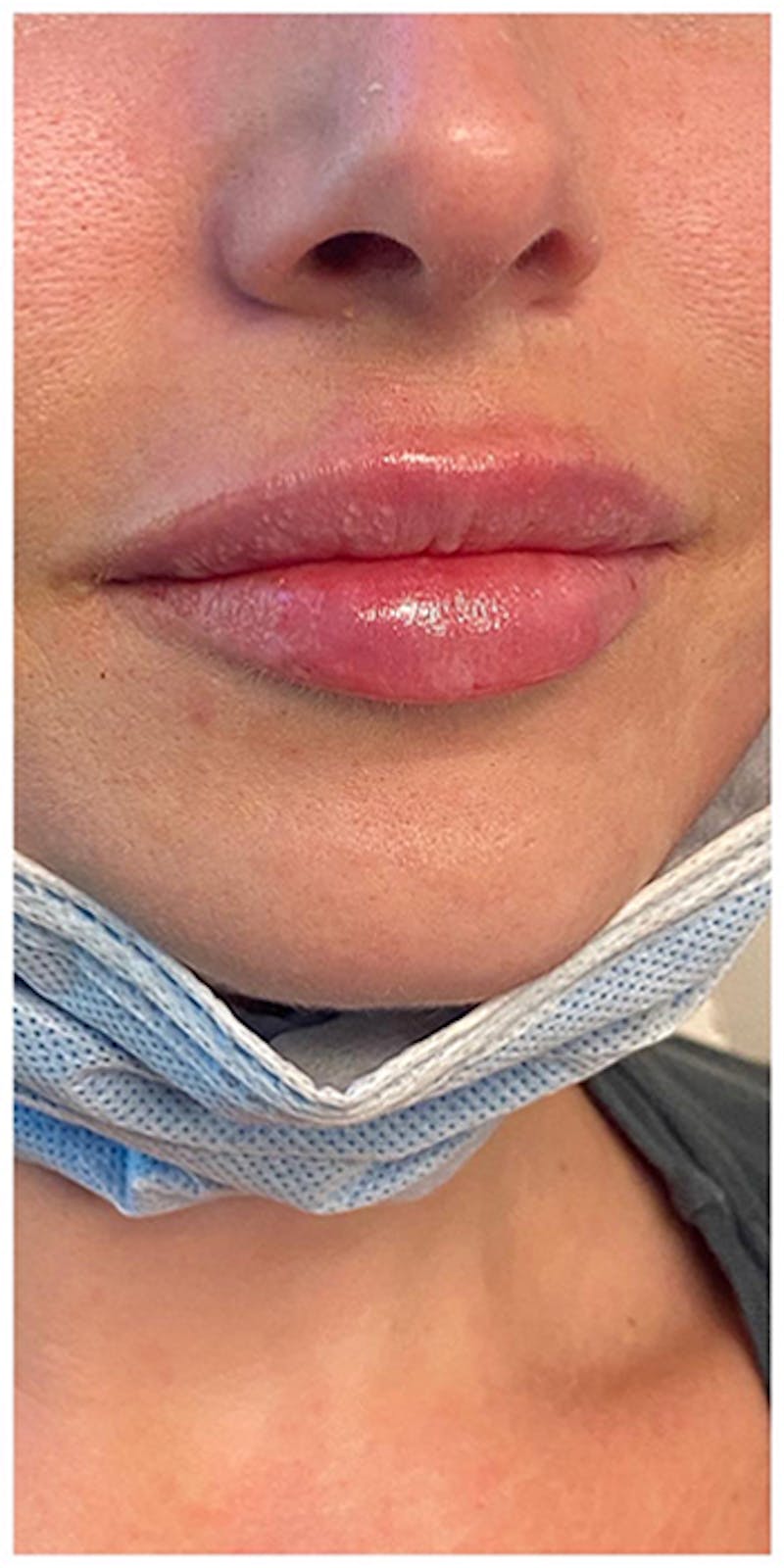 Lip Enhancement Before & After Gallery - Patient 133024119 - Image 4
