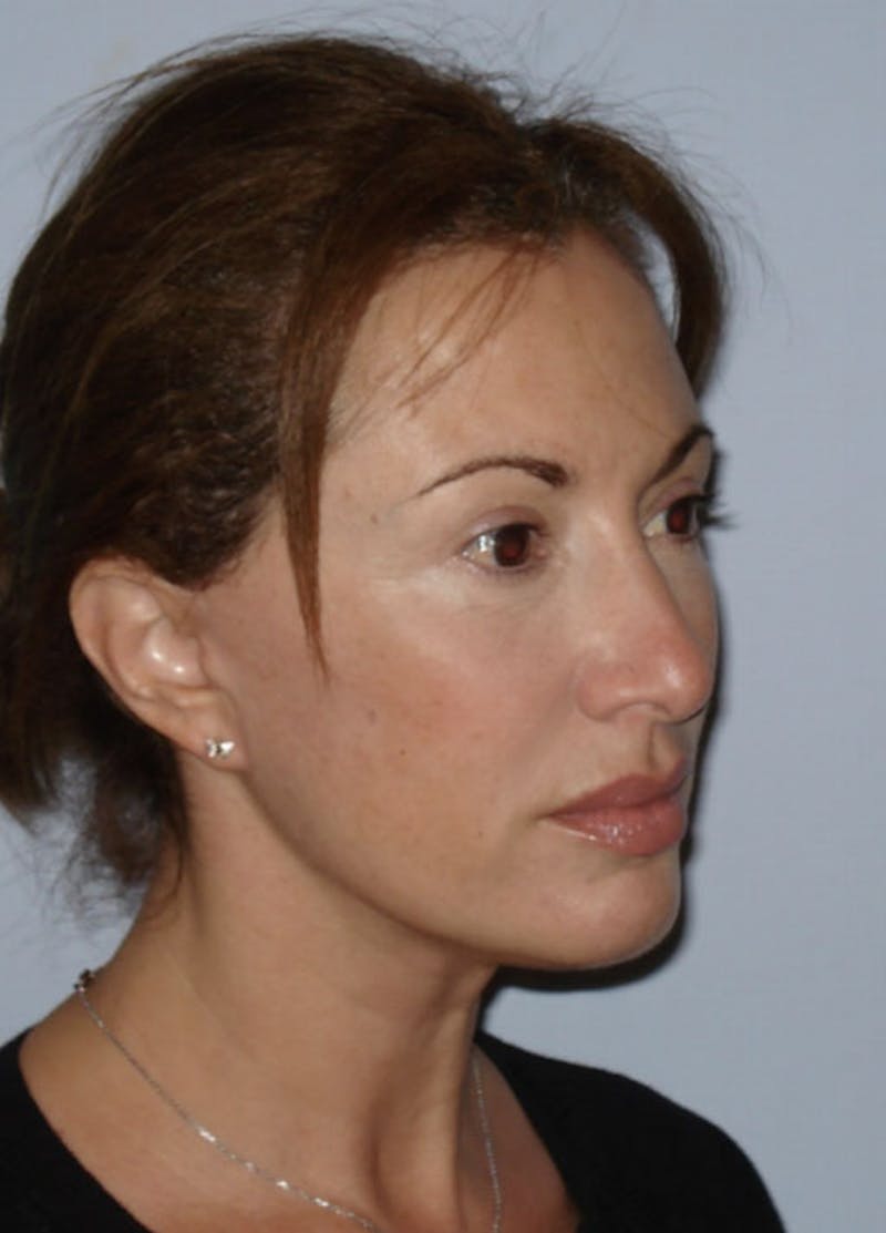 Facelift & Necklift Before & After Gallery - Patient 133024118 - Image 4
