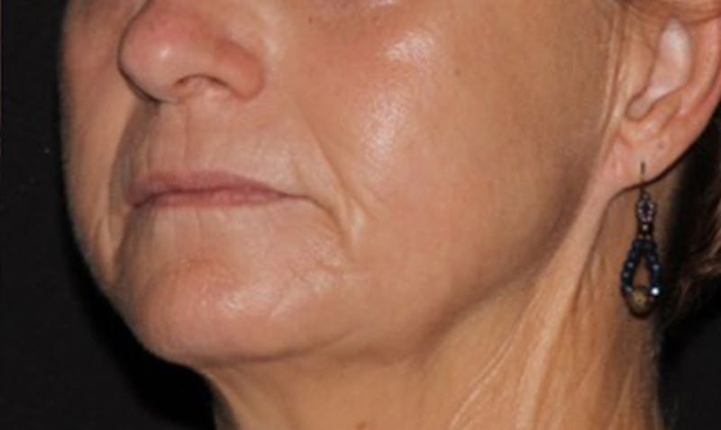 Laser Resurfacing Before & After Gallery - Patient 133024112 - Image 6