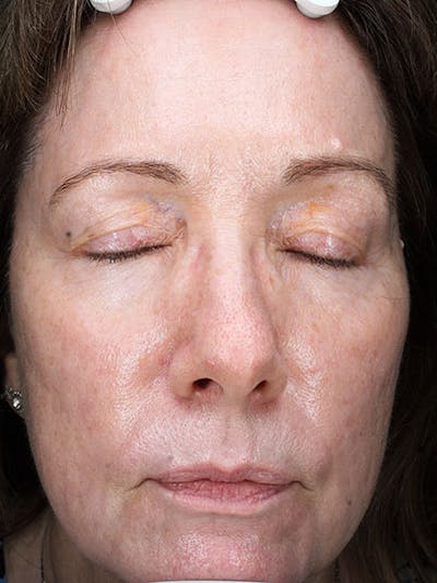 Skinpen / Microneedling Before & After Gallery - Patient 133024120 - Image 2