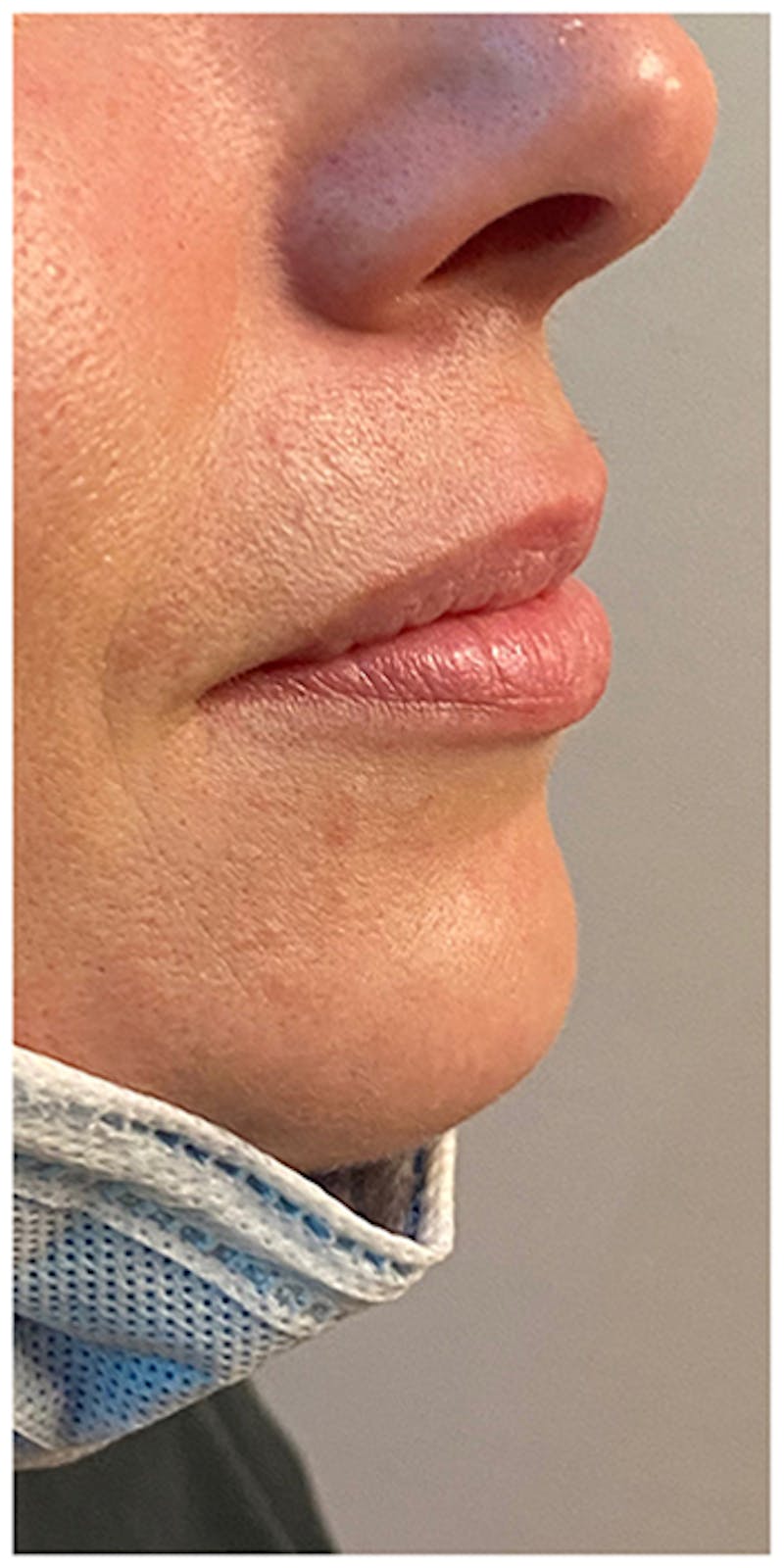 Lip Enhancement Before & After Gallery - Patient 133024119 - Image 5