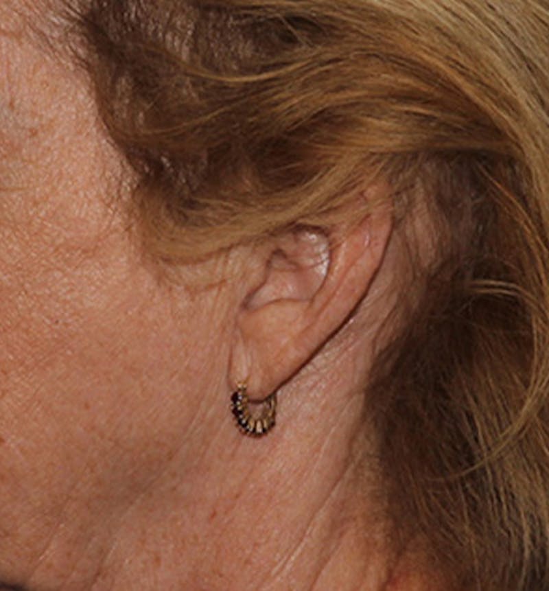 Facelift Scar Before & After Gallery - Patient 133024117 - Image 3