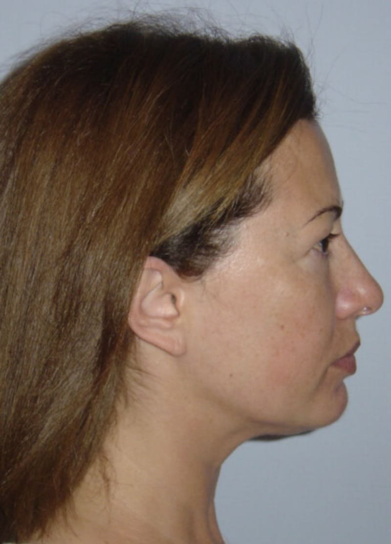 Facelift & Necklift Before & After Gallery - Patient 133024118 - Image 5