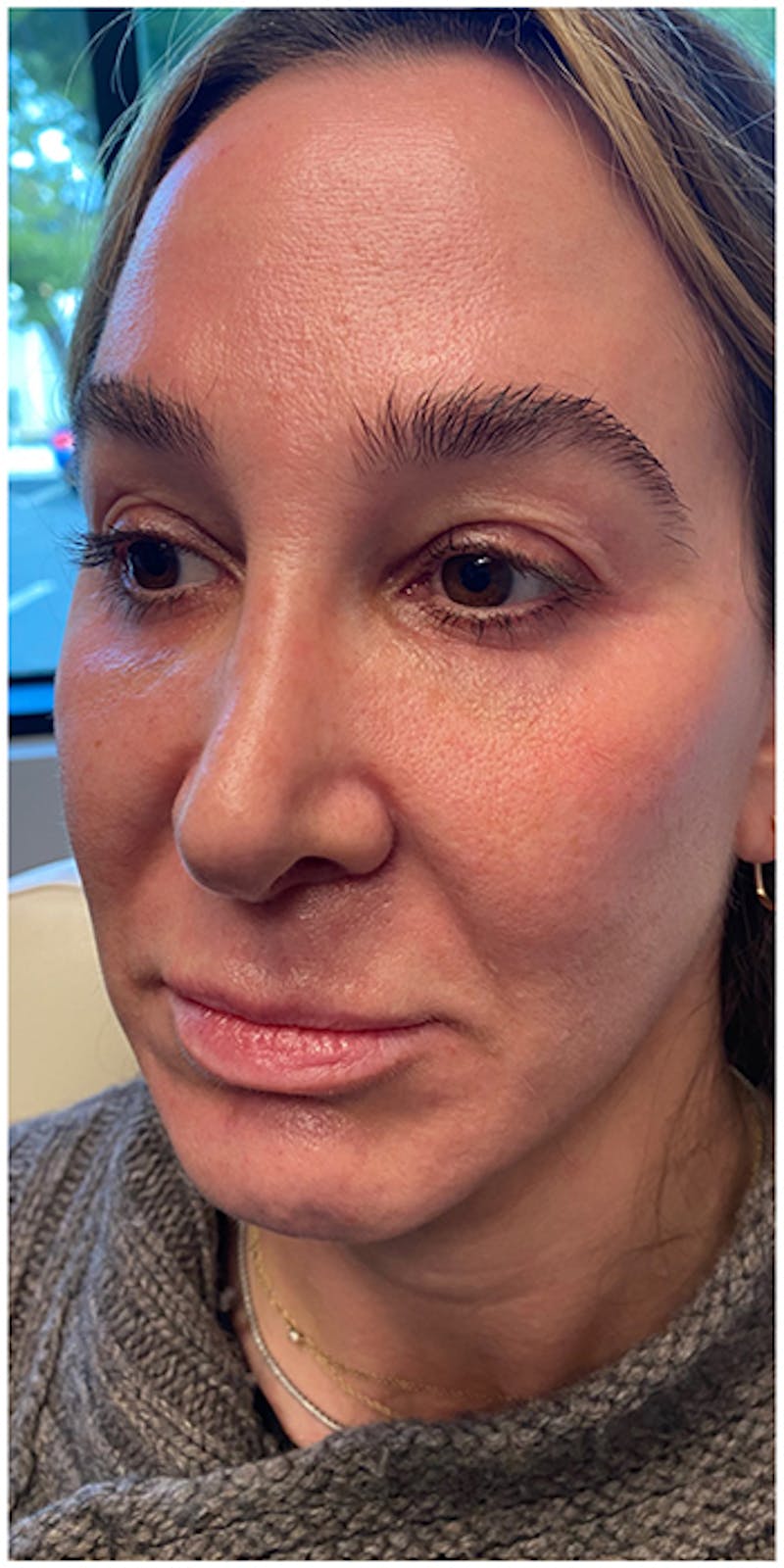 Dermal Fillers Before & After Gallery - Patient 133024123 - Image 3