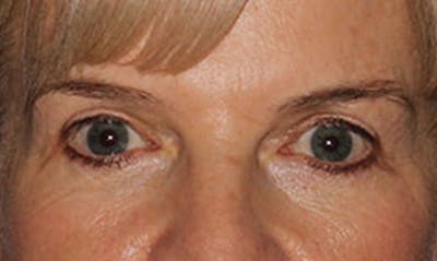 Laser Resurfacing Before & After Gallery - Patient 133024122 - Image 1