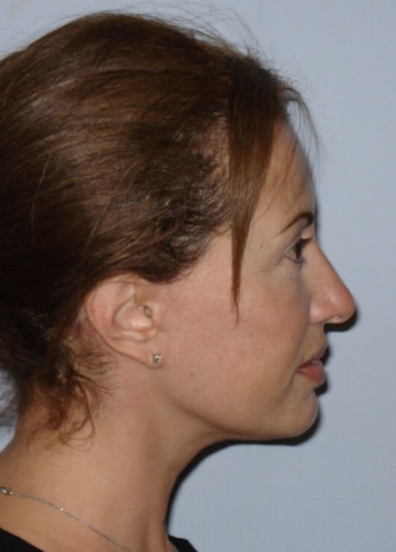 Facelift & Necklift Before & After Gallery - Patient 133024118 - Image 6