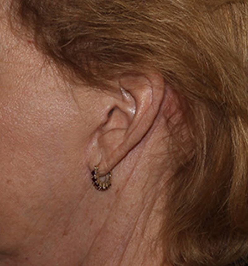 Facelift Scar Before & After Gallery - Patient 133024117 - Image 4