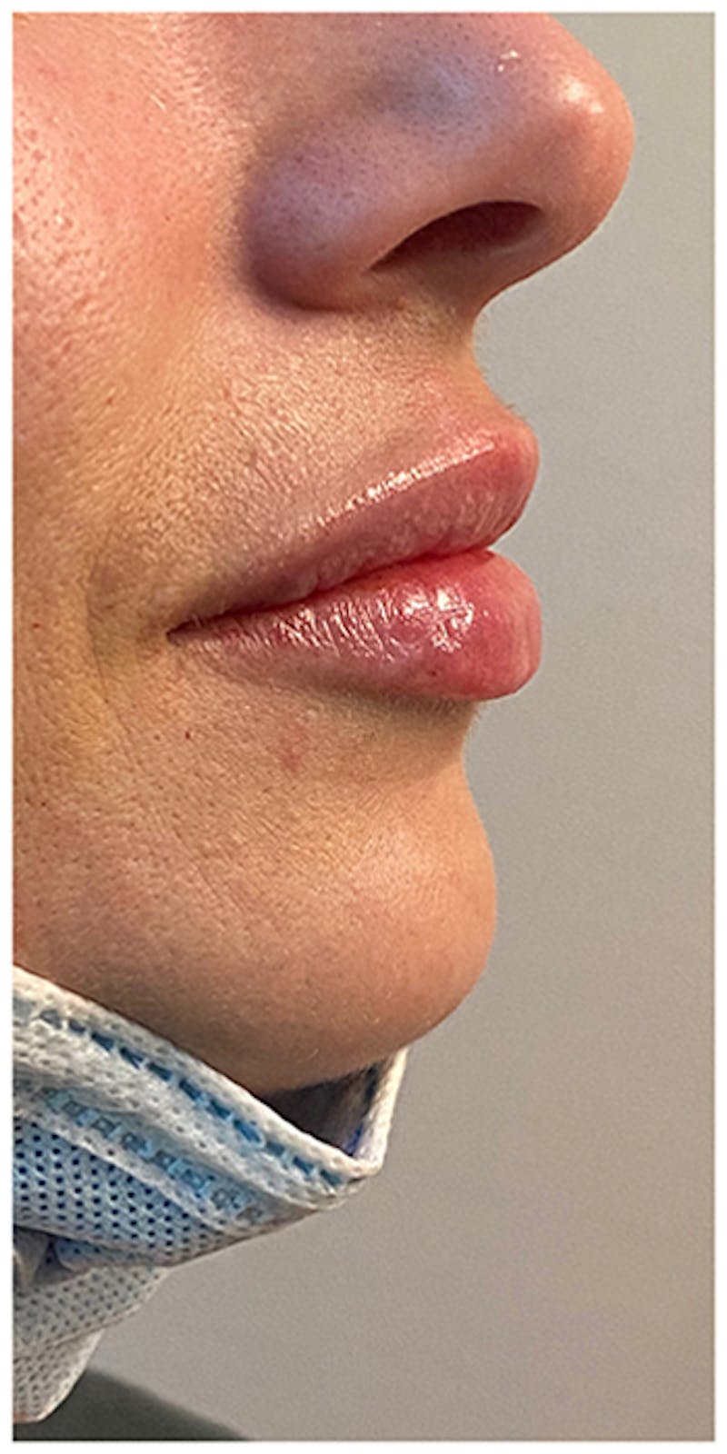 Lip Enhancement Before & After Gallery - Patient 133024119 - Image 6