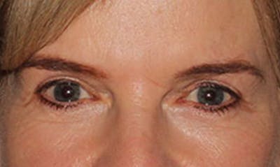 Laser Resurfacing Before & After Gallery - Patient 133024122 - Image 2