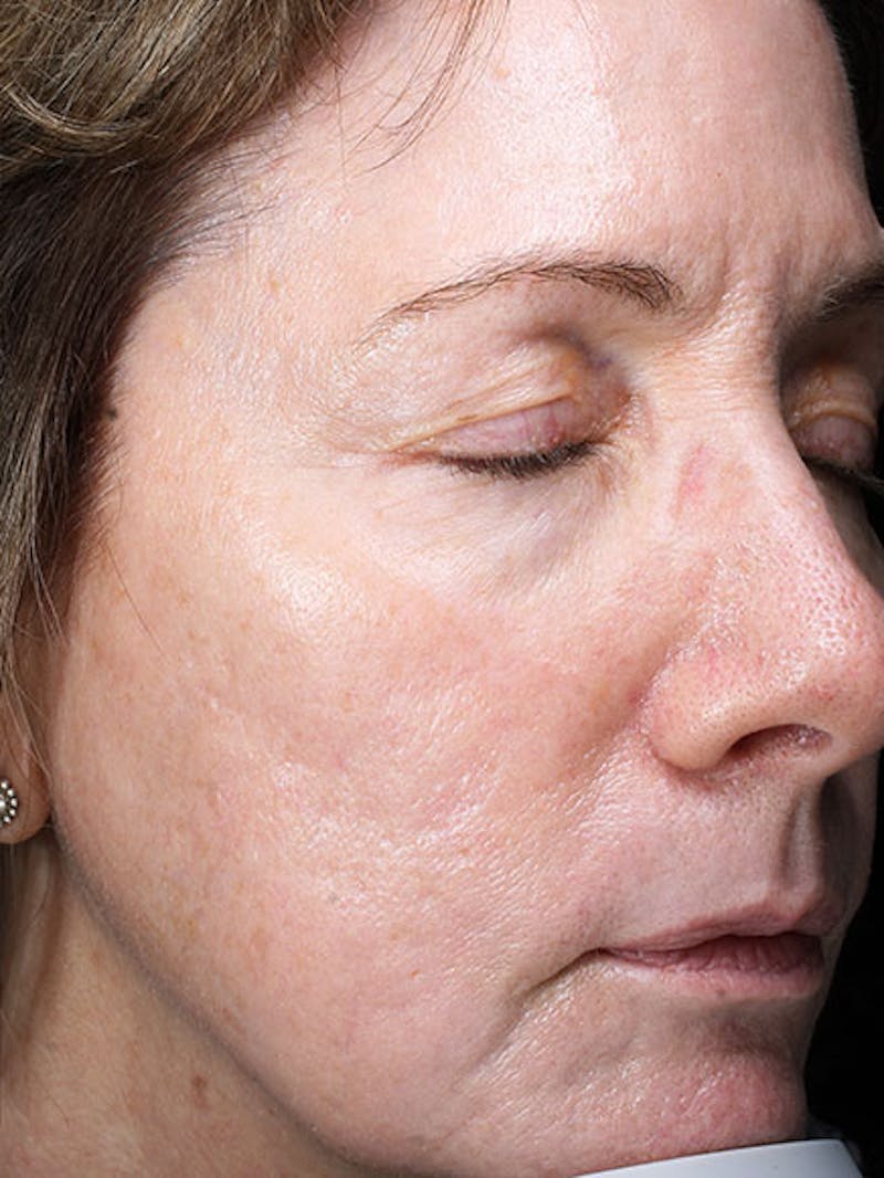 Skinpen / Microneedling Before & After Gallery - Patient 133024120 - Image 4