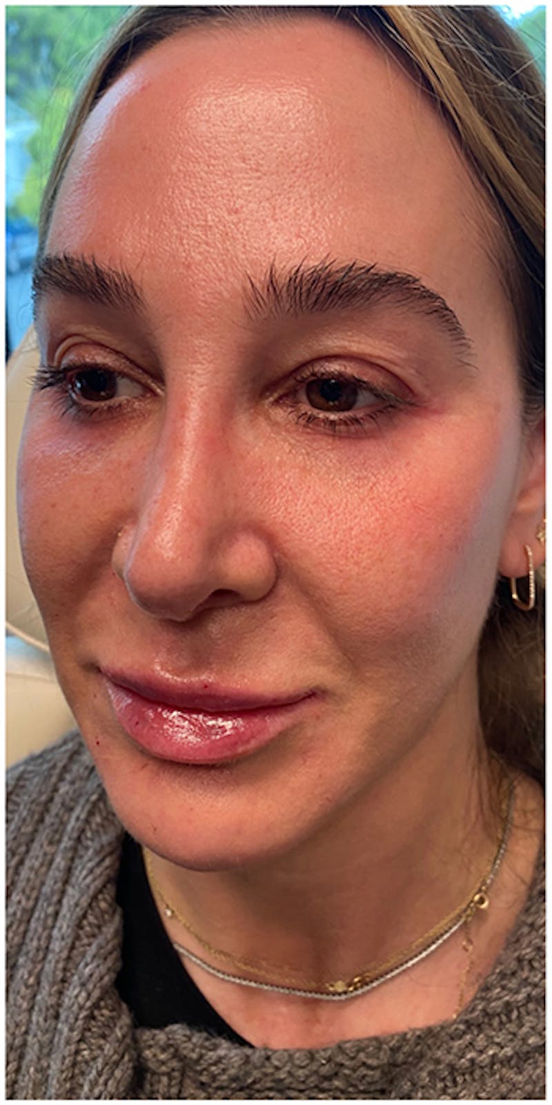 Dermal Fillers Before & After Gallery - Patient 133024123 - Image 4
