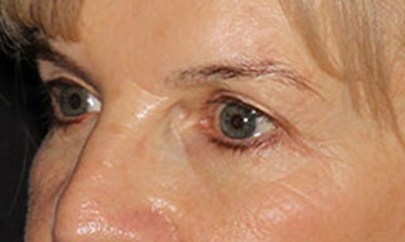 Laser Resurfacing Before & After Gallery - Patient 133024122 - Image 3