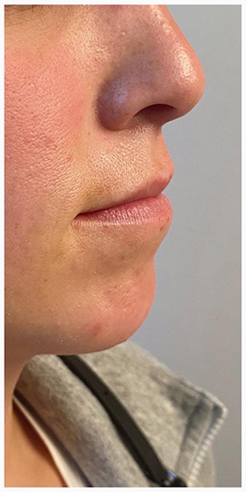 Lip Enhancement Before & After Gallery - Patient 133024127 - Image 1