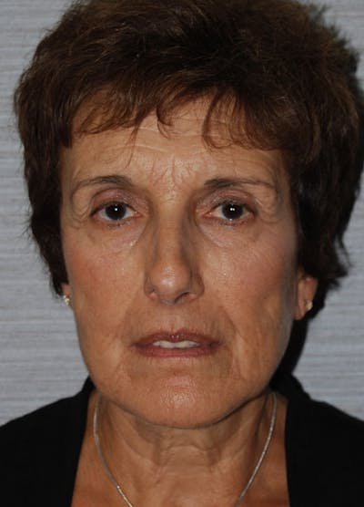 Facelift & Necklift Before & After Gallery - Patient 133024121 - Image 1