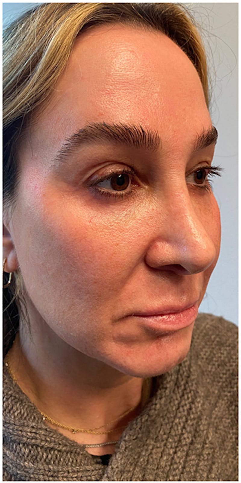Dermal Fillers Before & After Gallery - Patient 133024123 - Image 5