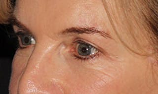 Laser Resurfacing Before & After Gallery - Patient 133024122 - Image 4
