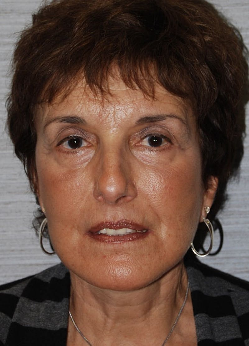 Facelift & Necklift Before & After Gallery - Patient 133024121 - Image 2