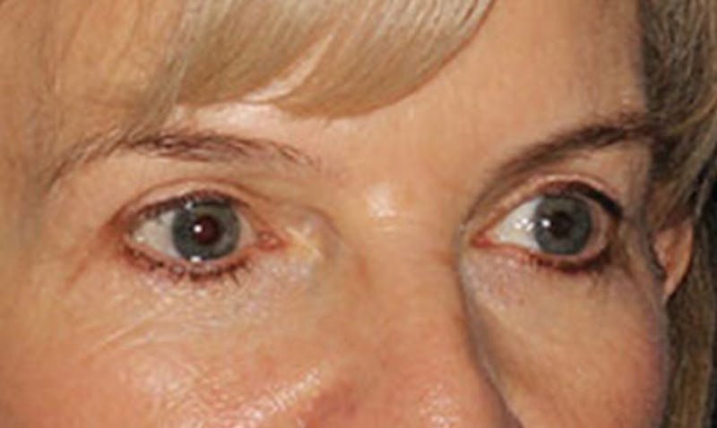 Laser Resurfacing Before & After Gallery - Patient 133024122 - Image 5