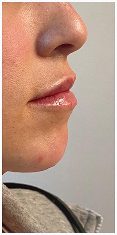 Lip Enhancement Before & After Gallery - Patient 133024127 - Image 2