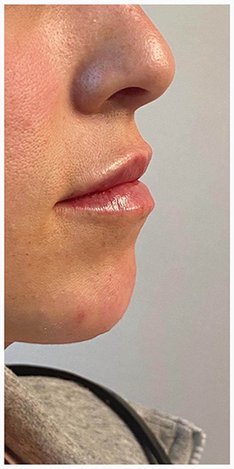 Lip Enhancement Before & After Gallery - Patient 133024127 - Image 2