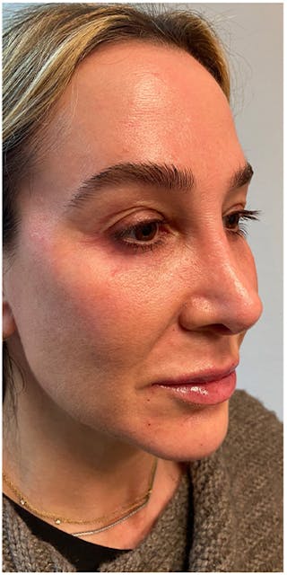 Dermal Fillers Before & After Gallery - Patient 133024123 - Image 6