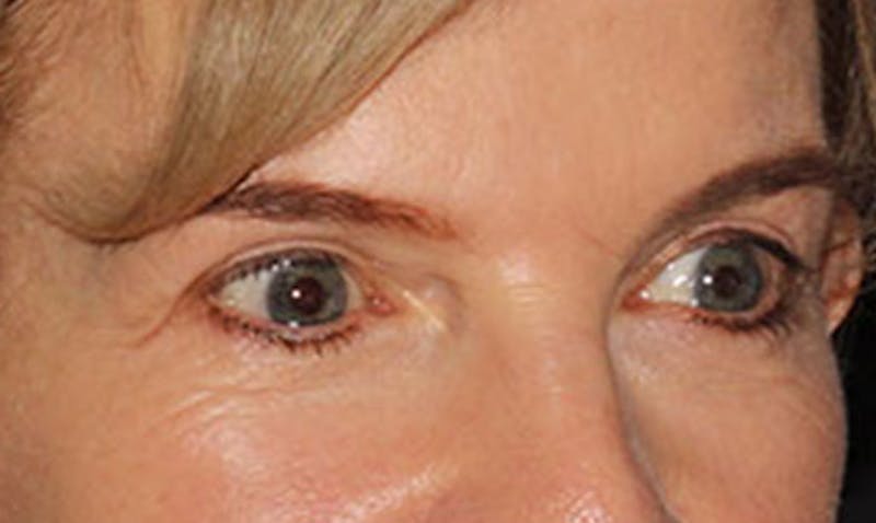 Laser Resurfacing Before & After Gallery - Patient 133024122 - Image 6