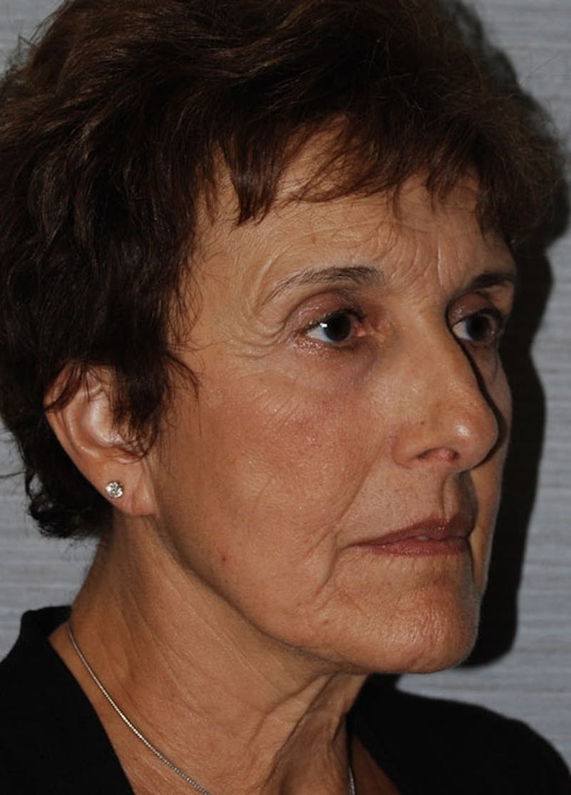 Facelift & Necklift Before & After Gallery - Patient 133024121 - Image 3