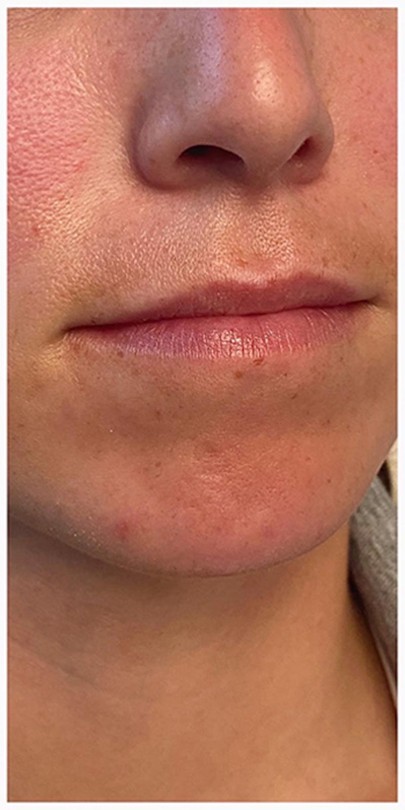 Lip Enhancement Before & After Gallery - Patient 133024127 - Image 3
