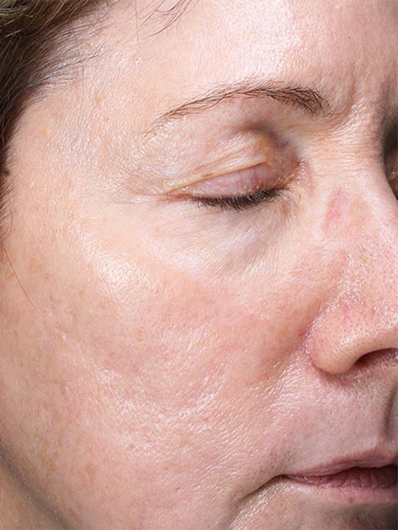 Skinpen / Microneedling Before & After Gallery - Patient 133024120 - Image 8