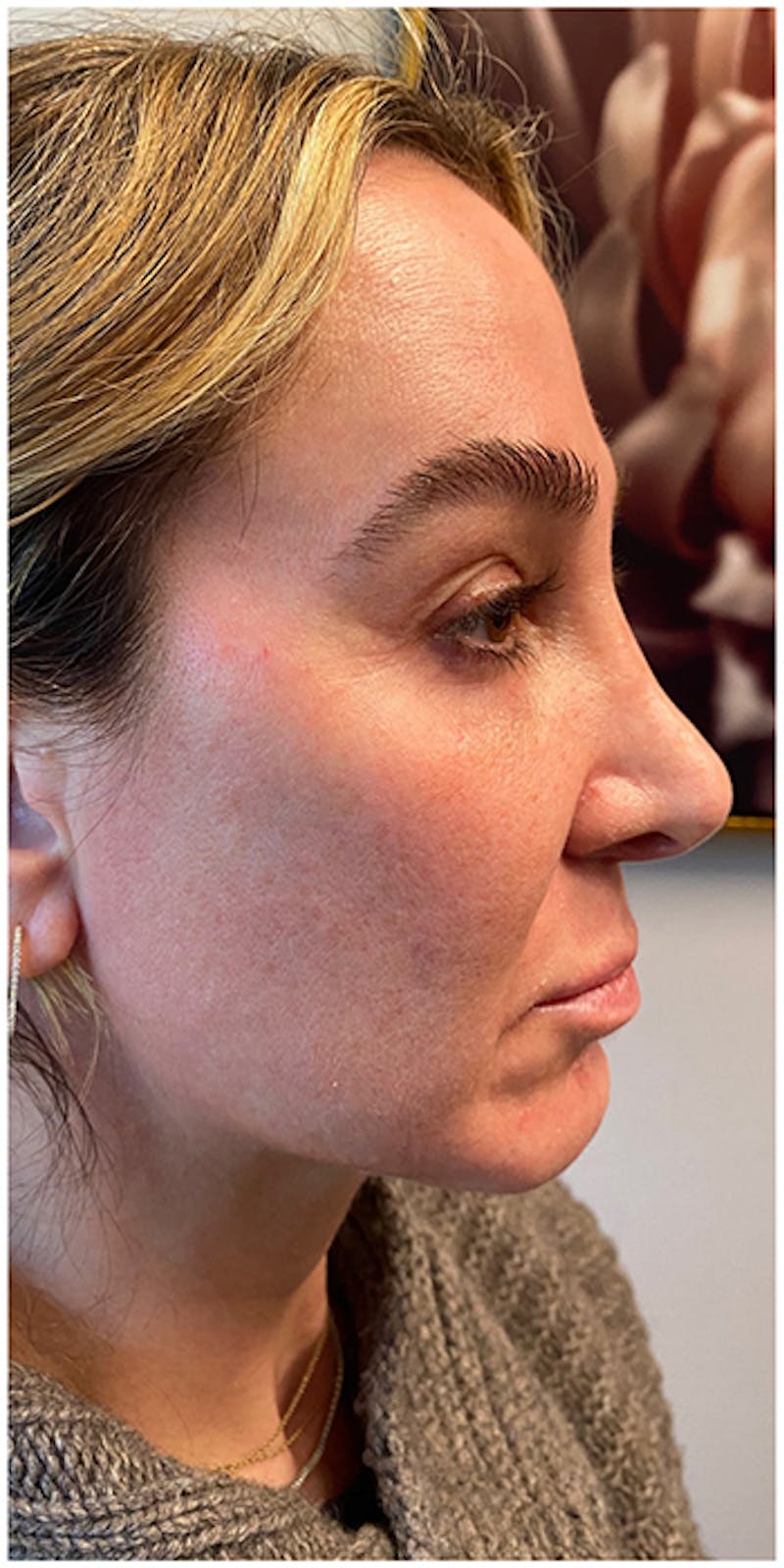 Dermal Fillers Before & After Gallery - Patient 133024123 - Image 7