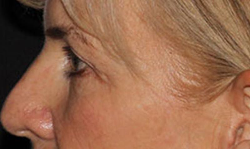 Laser Resurfacing Before & After Gallery - Patient 133024122 - Image 7