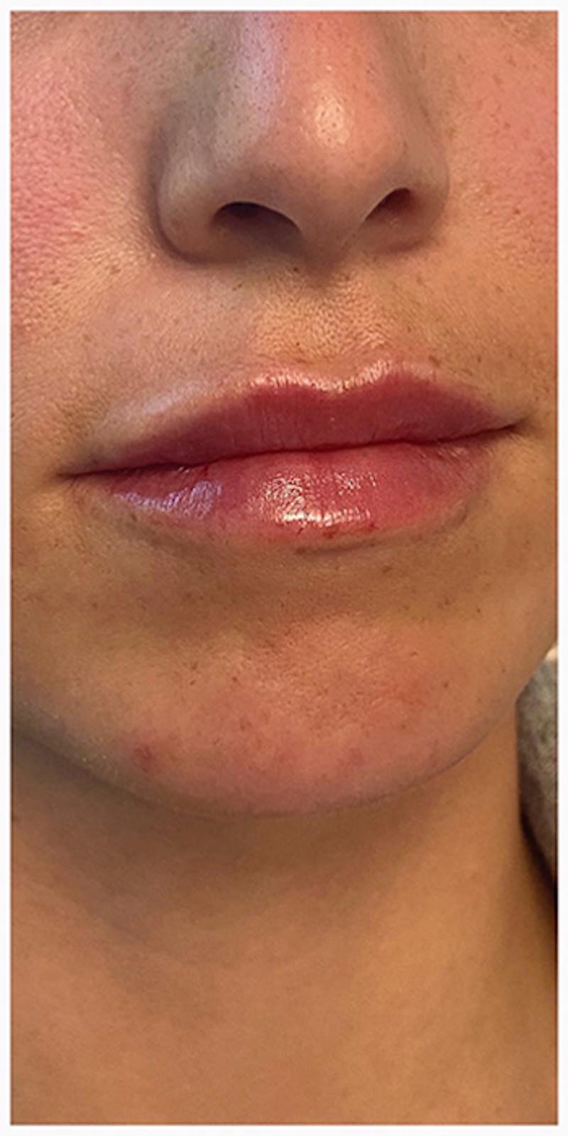 Lip Enhancement Before & After Gallery - Patient 133024127 - Image 4